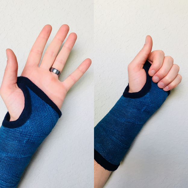 5 Gentle and Safe Finger Exercises in a Wrist Cast - Virtual Hand Care
