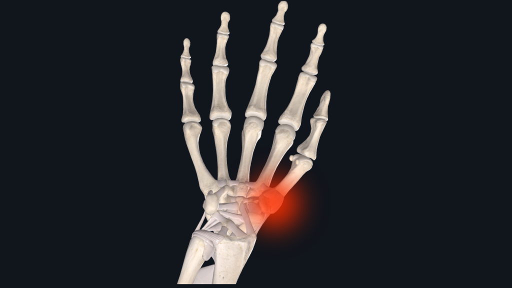 CMC thumb arthritis image
