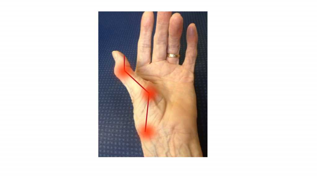 Picture shows loss of palmar arch and thumb web space due to thumb arthritis