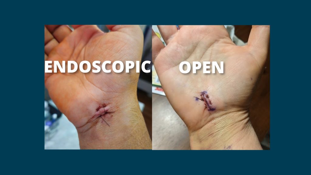 Side by side endoscopic versus open carpal tunnel releases